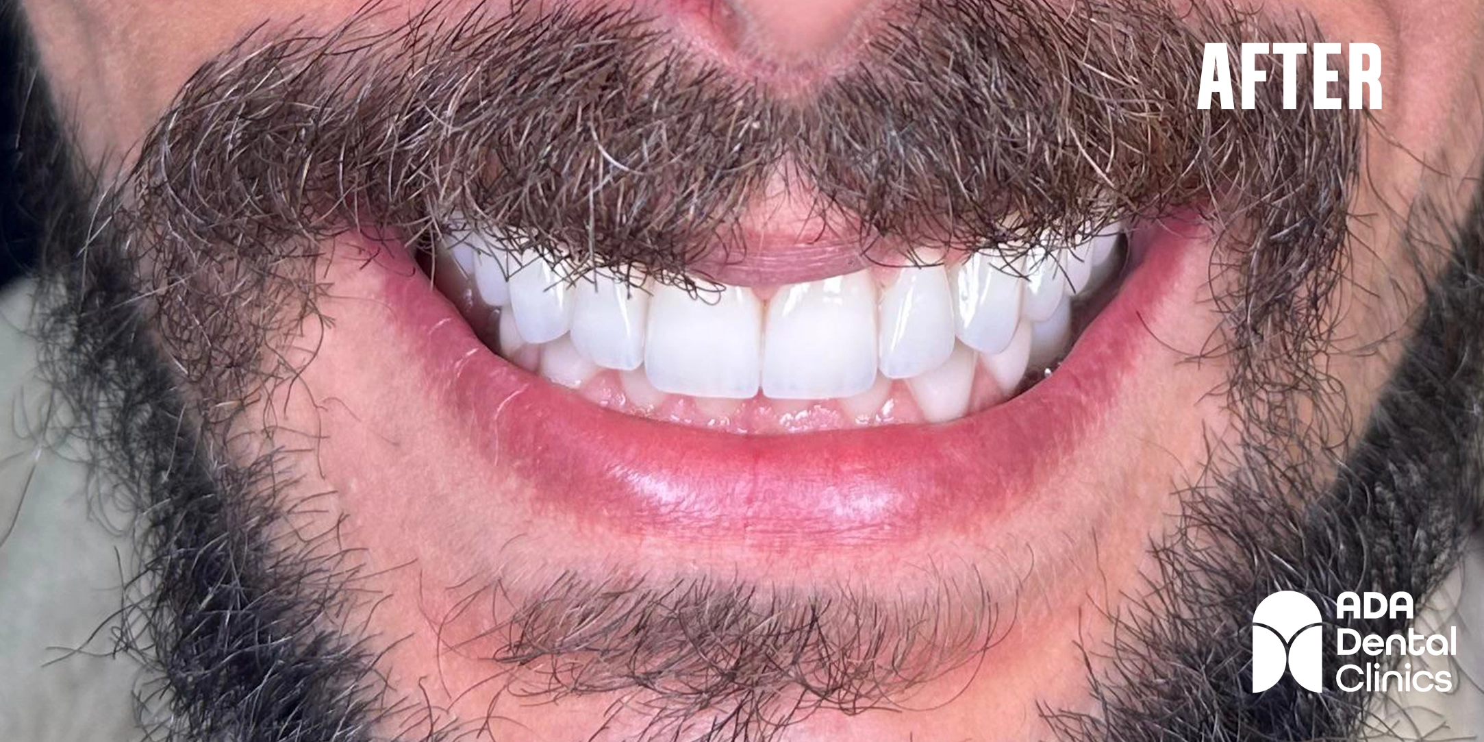 after photo